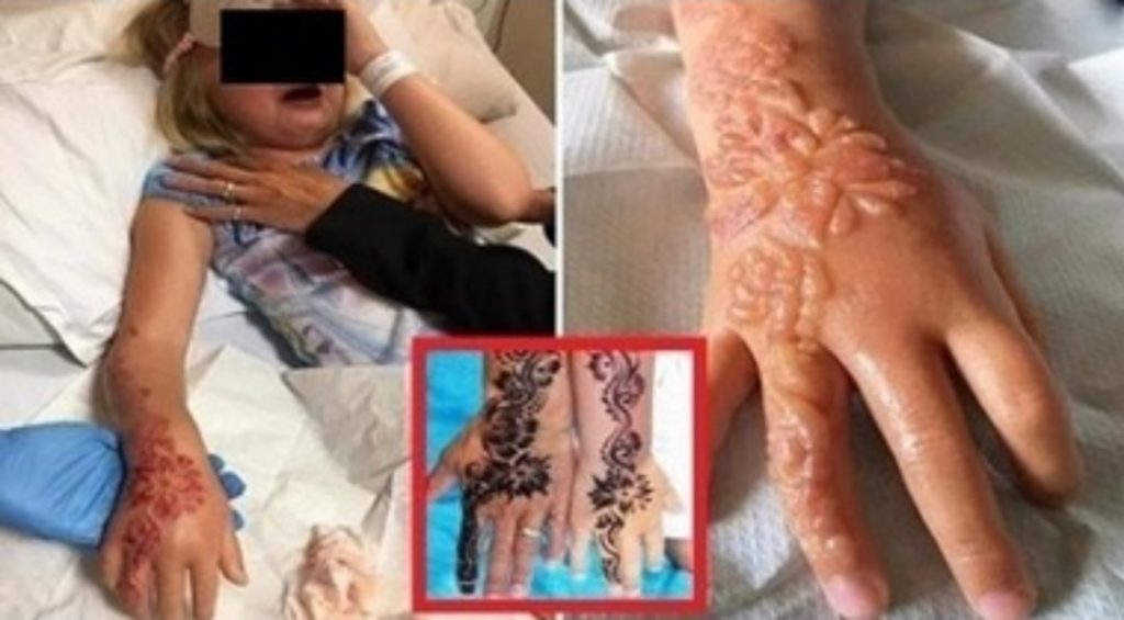 Fa un tatuaggio all’hennè in vacanza, bimba di 7 anni resterà sfigurata per tutta la vita