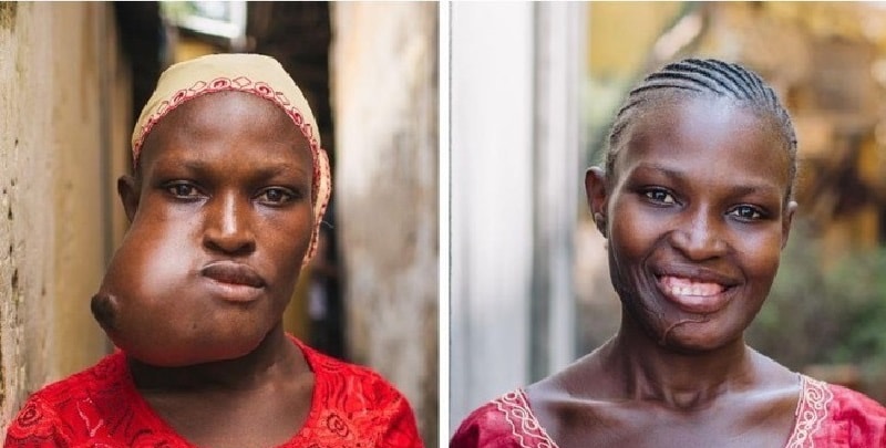 Isatu, una storia durata 20 anni prima di riuscire a sorridere (Foto)