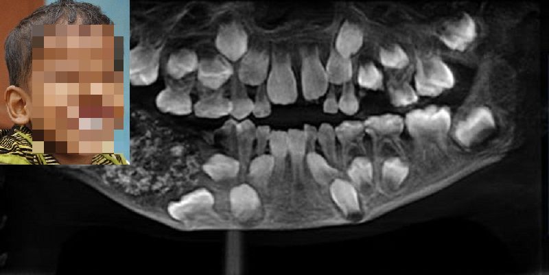 Bimbo aveva fastidio alla mascella, gli trovano 526 denti