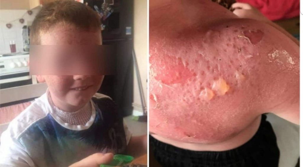 Bambino di 5 anni ustionato dopo aver messo una crema protezione 50 [FOTO]