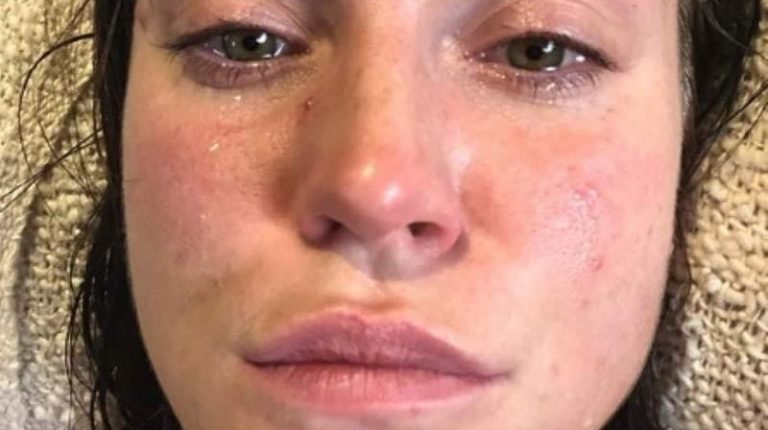 “I medici sono stati chiari”, Vicky Pattison e i problemi di salute a causa gli eccessi nella vita