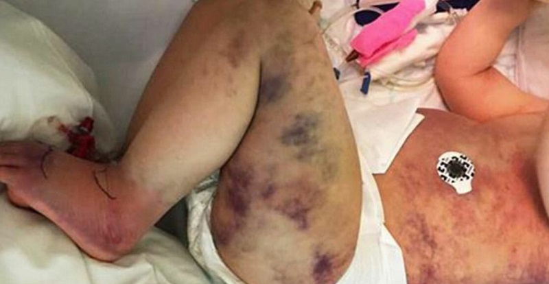 Una madre pensa che suo figlio sia stato punto da una vespa ma poi il suo corpo è diventato blu