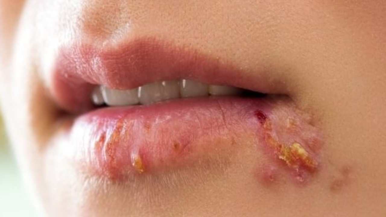 Herpes labiale, non è da sottovalutare | Può essere  una malattia molto seria